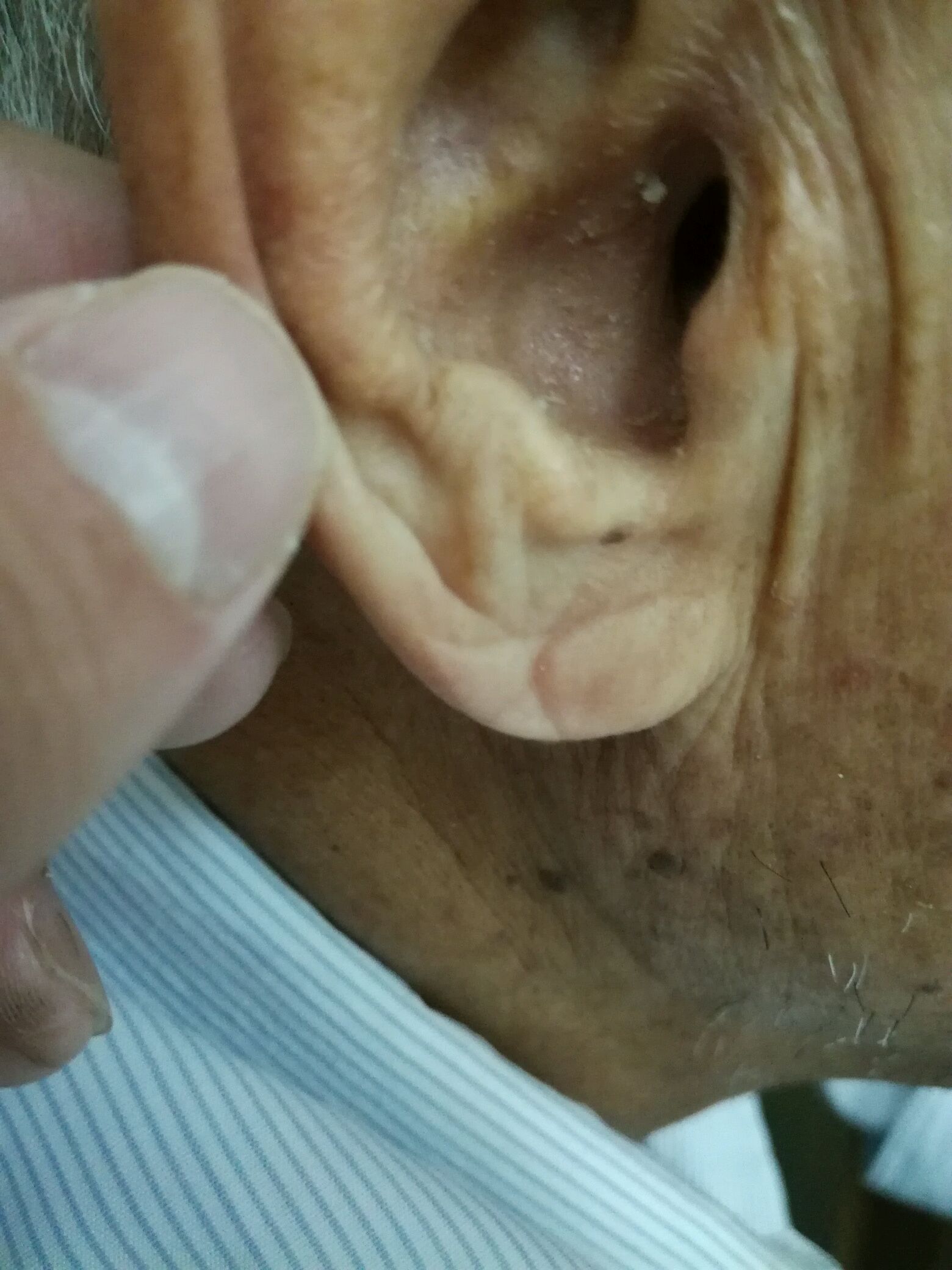 折耳征心脑血管病的提示特征