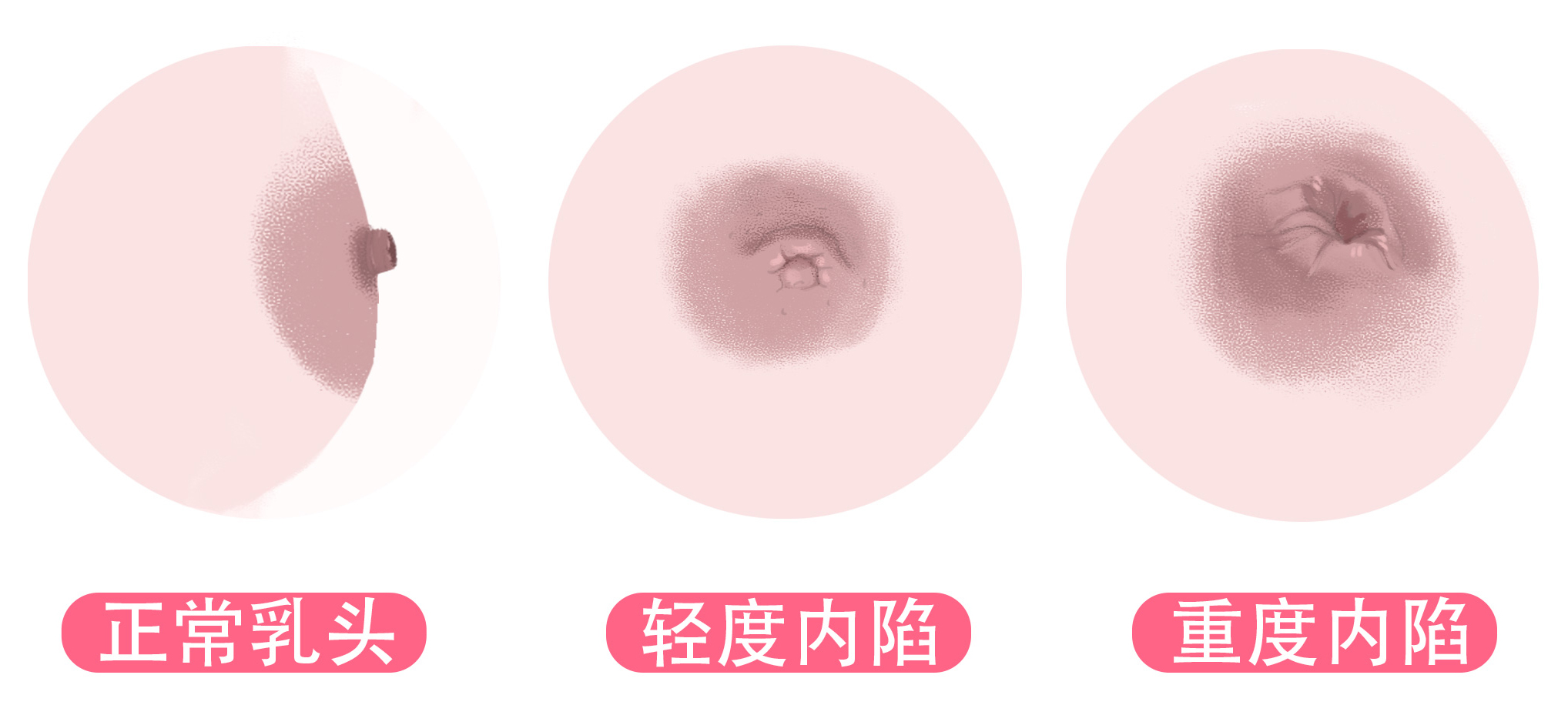 新生女宝要不要挤乳头？谨记：这种老传统会害了宝宝