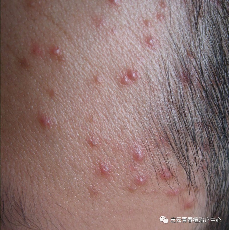毛囊炎常见的发病原因和处理方法
