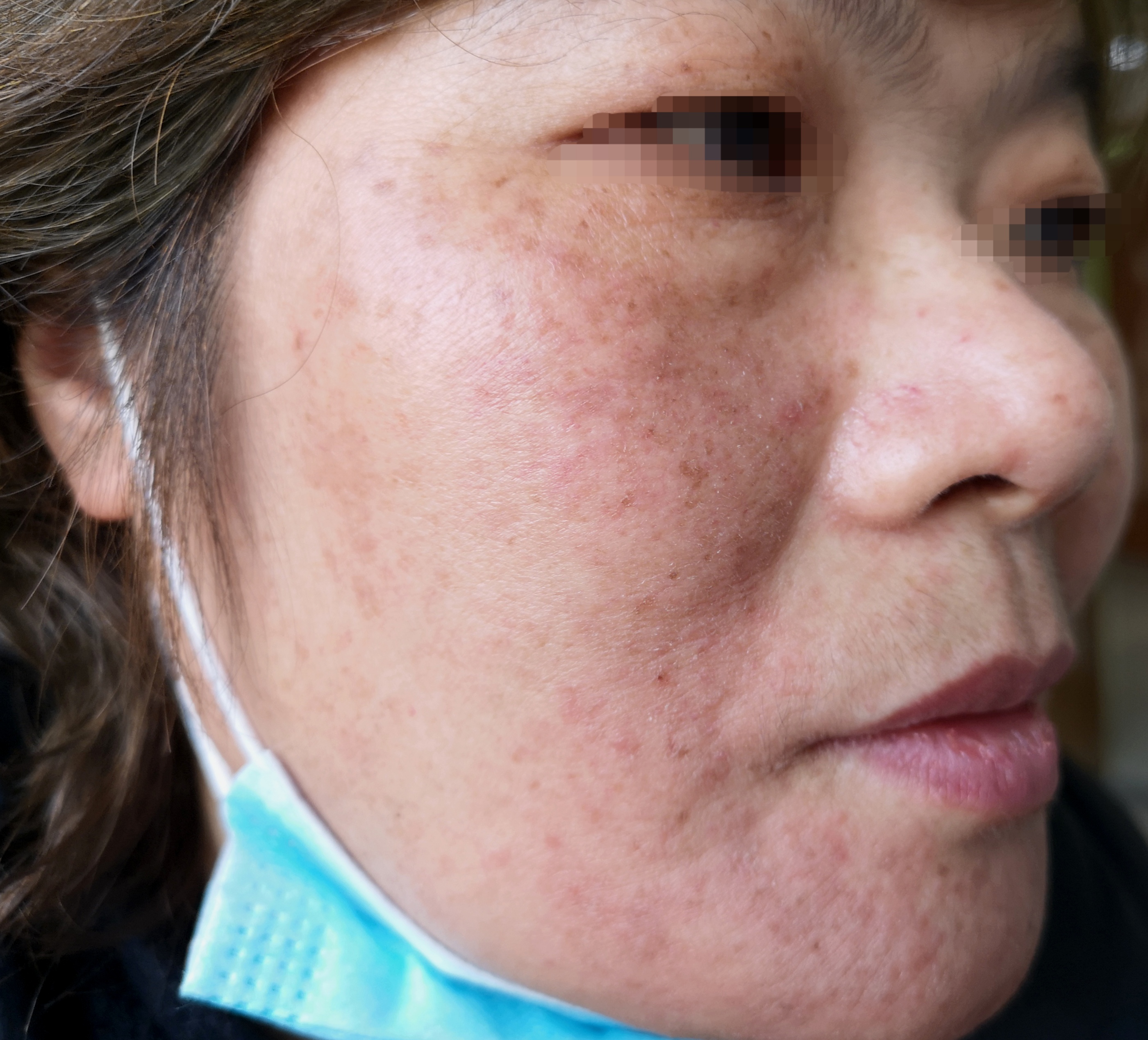 难受的激素依赖性皮炎