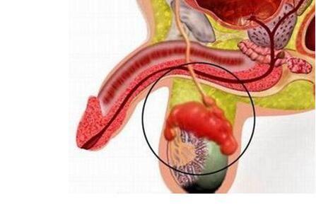 睾丸附睾炎是什么症状图片