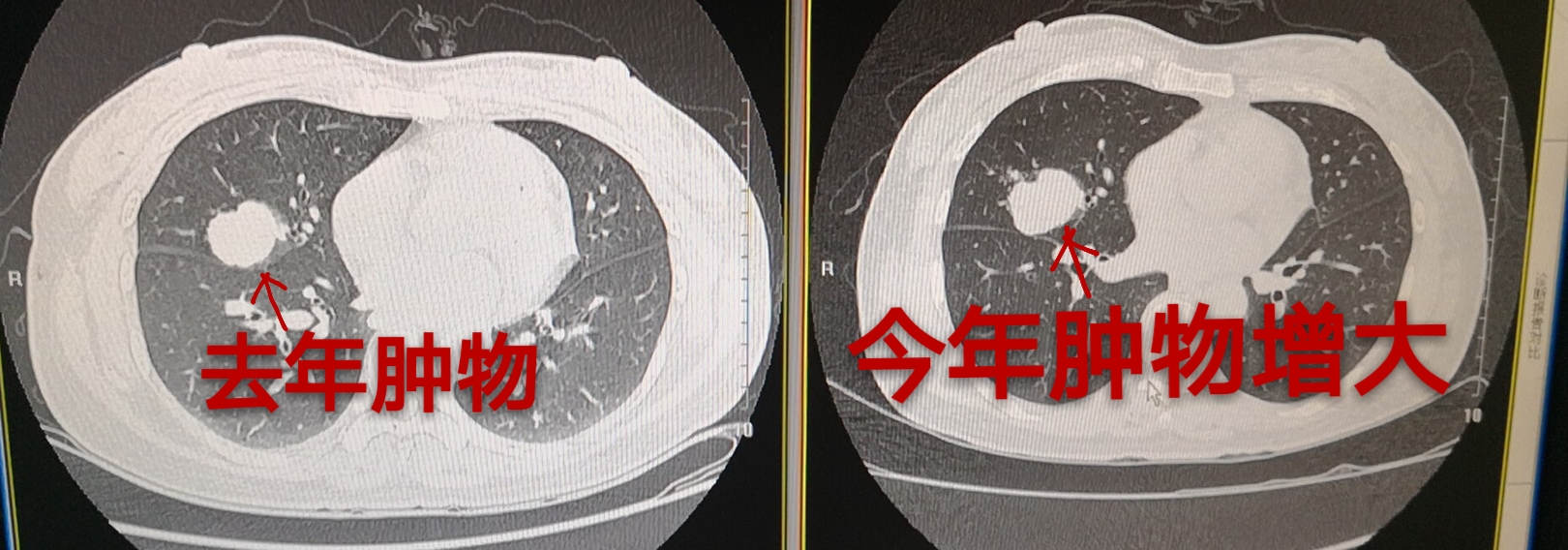 妖怪看我火眼金睛揪出肺小結節中的殺人犯