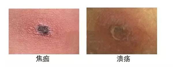 焦痂或溃疡形成,焦痂或特征性溃疡为恙虫极具特征的表现.