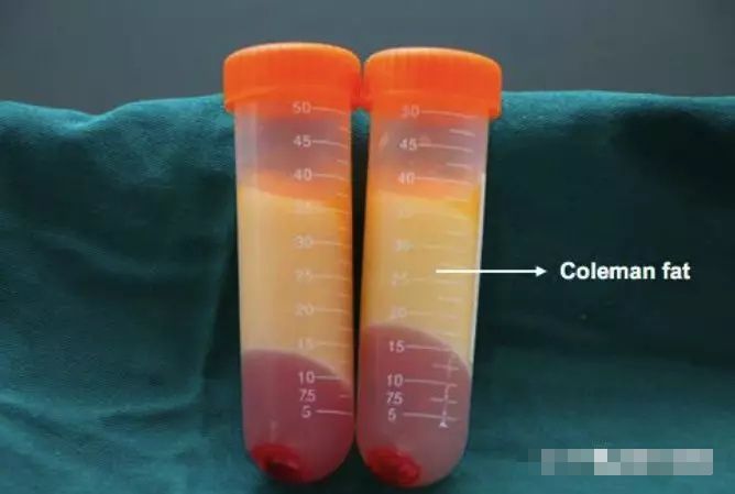 广州瑞港科普| 自体脂肪移植安全吗,有几种方案选择,孰优孰劣