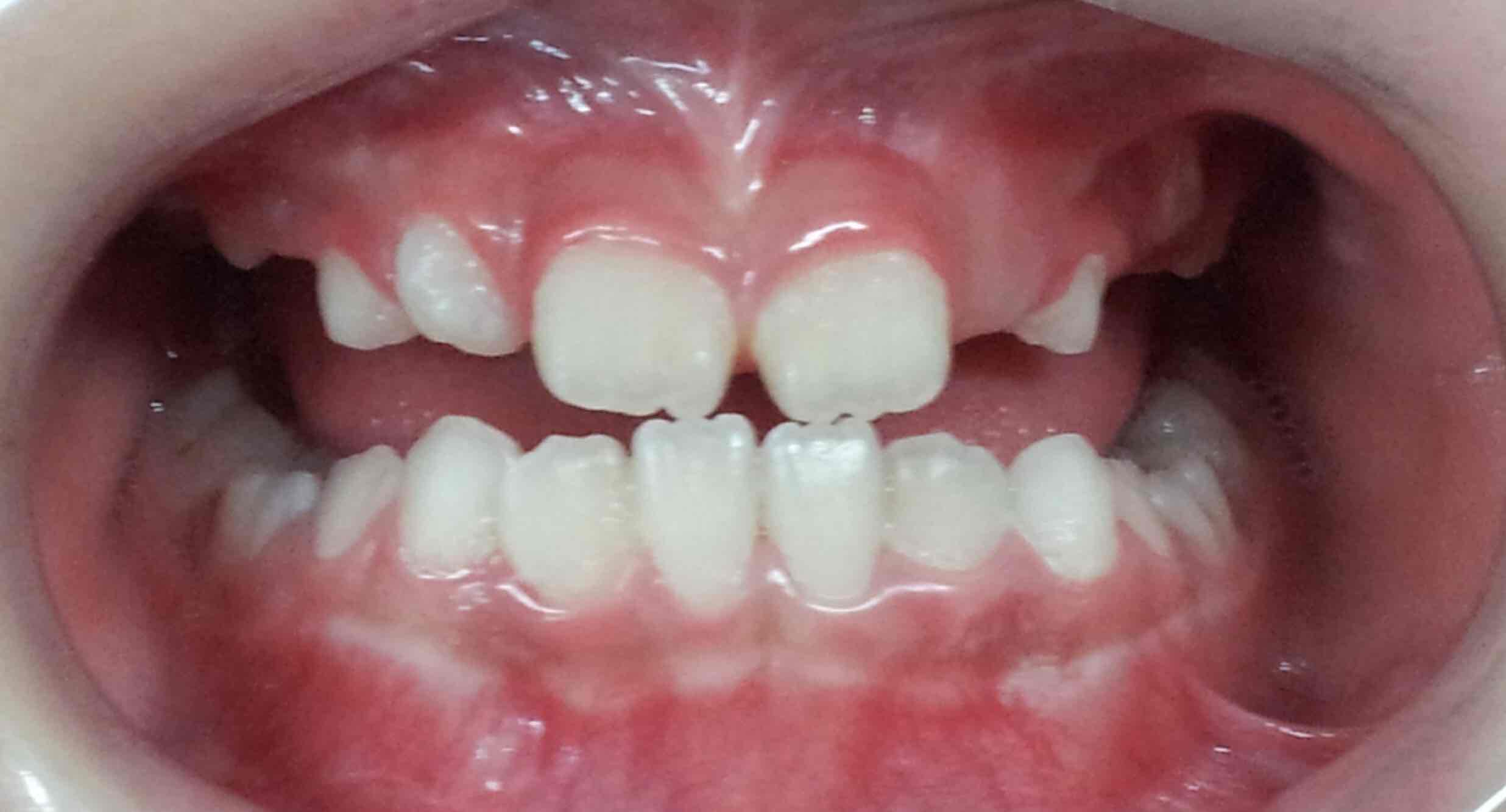 上颌与下颌在三维方向上发育的差异,会导致牙齿排列和牙弓宽度及高度