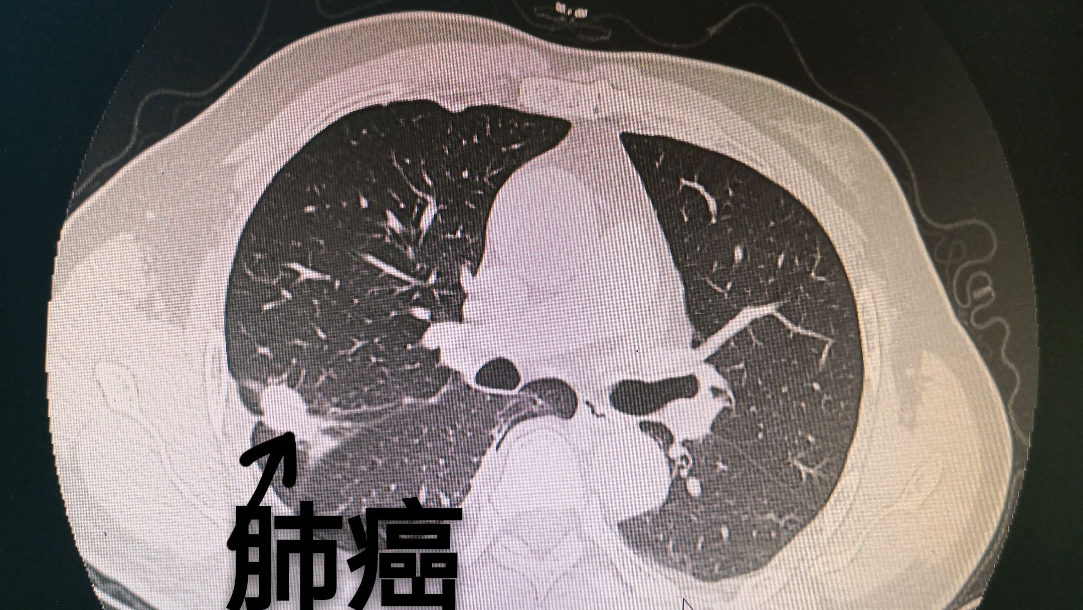 也沒有太在意,這次來我們醫院一檢查就是晚期肺癌