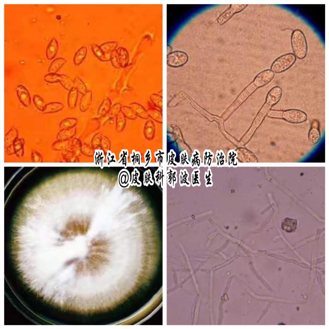 医生怀疑灰指甲,刮取指或趾甲的甲角质,在显微镜下观察,发现菌丝即可