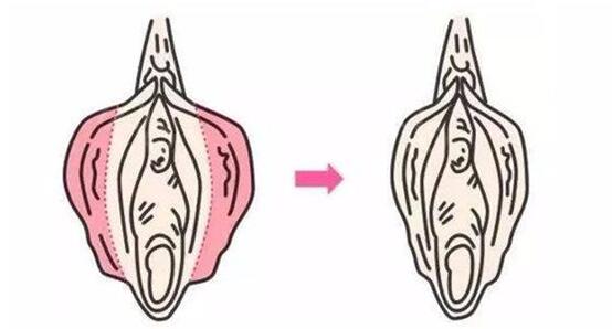 私密整形是心理需要还是生理需要?