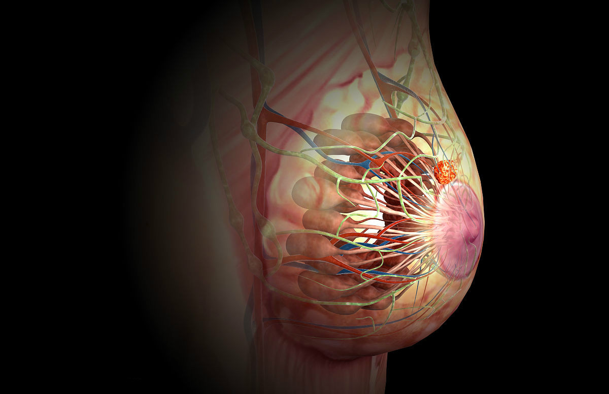 乳腺肿瘤有六个标志,如果出现三个以上,提示肿瘤已是中晚期