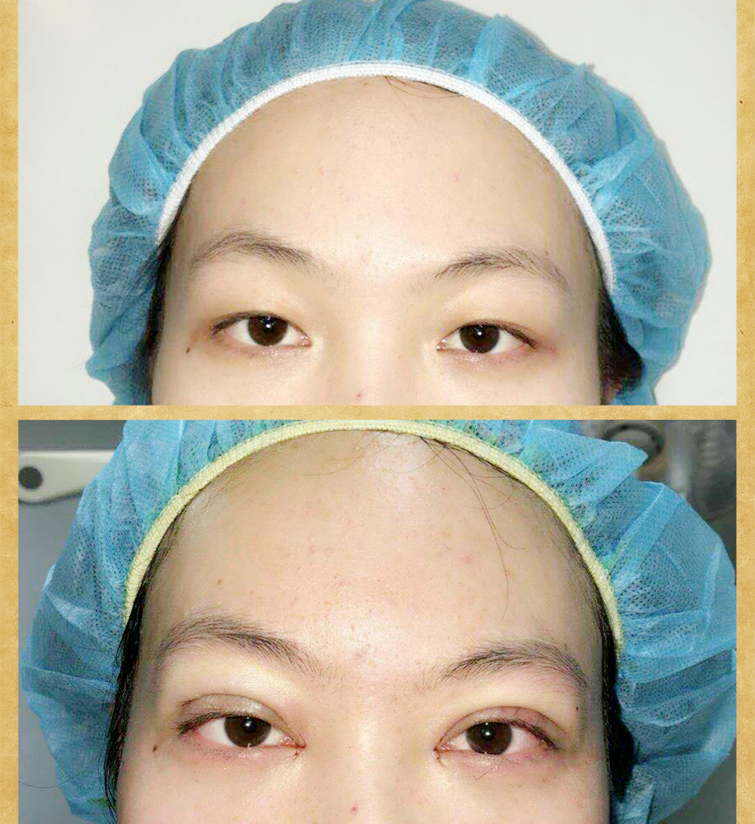 华东医院整形美容科主任刘天一眼部整形案例