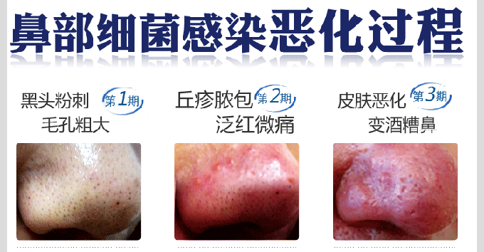 鼻头发红,只是因为天冷冻出来的吗?