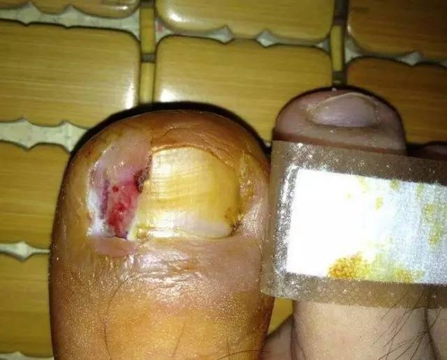 彻底根治甲沟炎-刘现英主任医师-爱问医生