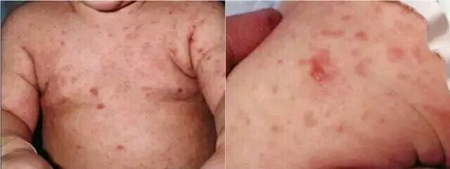 疥疮的预防与治疗