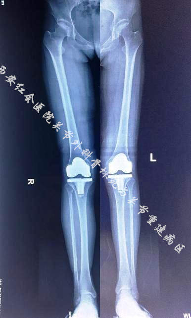 術後x線片檢查結果顯示:西安紅會醫院許鵬主任介紹,類風溼性關節炎大
