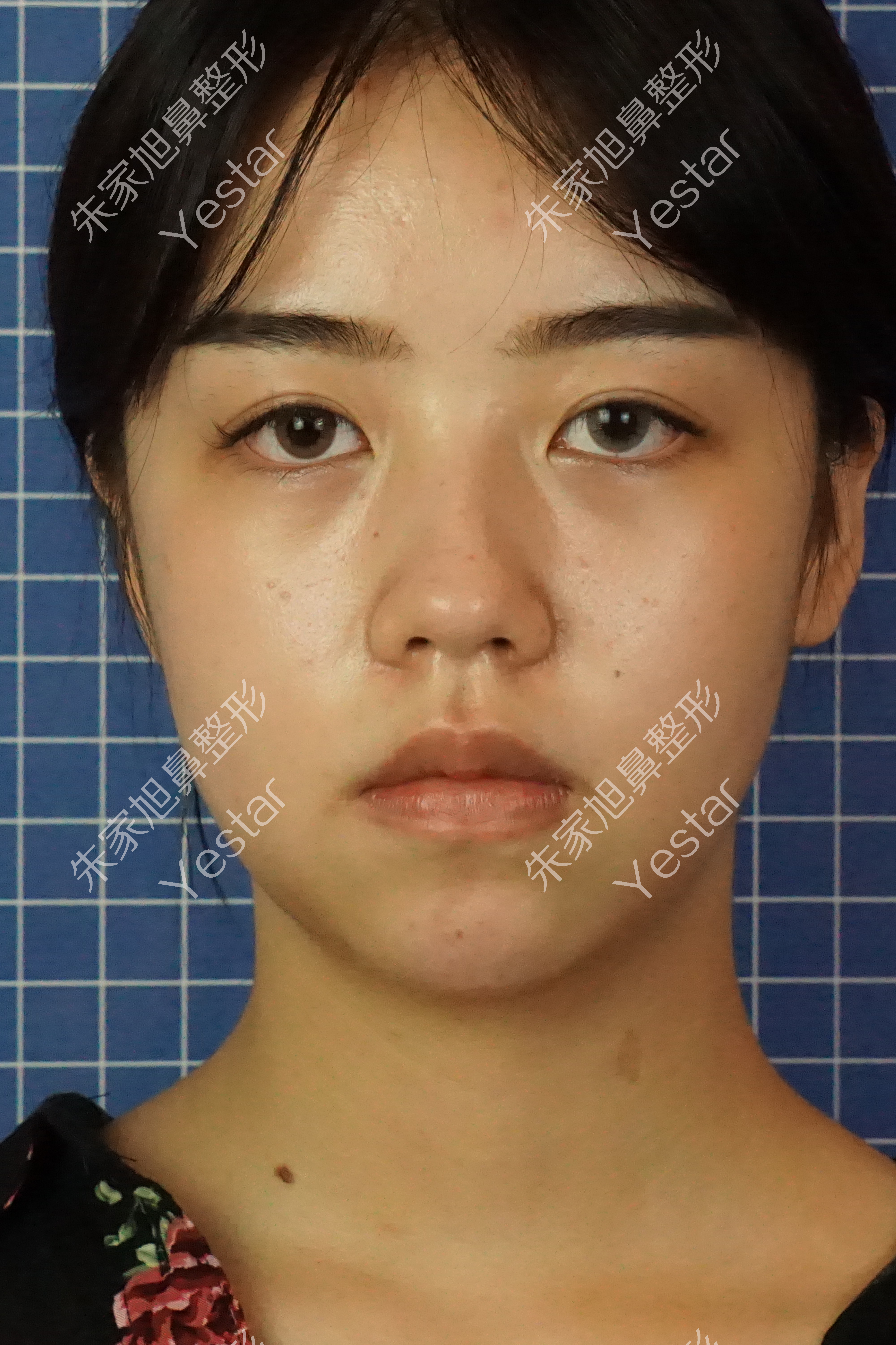 三,术前照片:二,术前诊断:姑娘的鼻子偏短,显得人中稍长,山根的凹陷