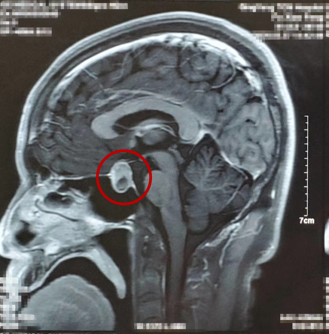 脑垂体瘤病人图片