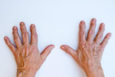 类风湿病友们可知如何预防手指变形