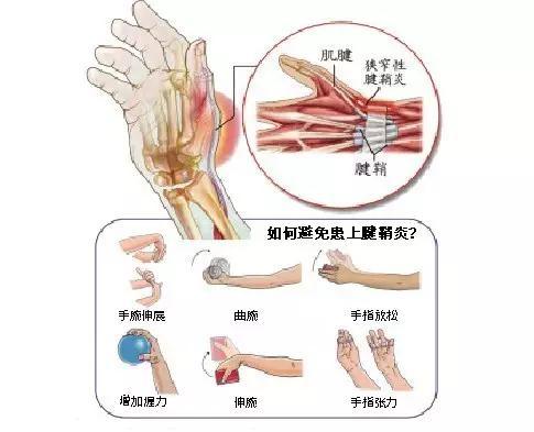 拇指腱鞘炎学会这几招轻松告别手机手