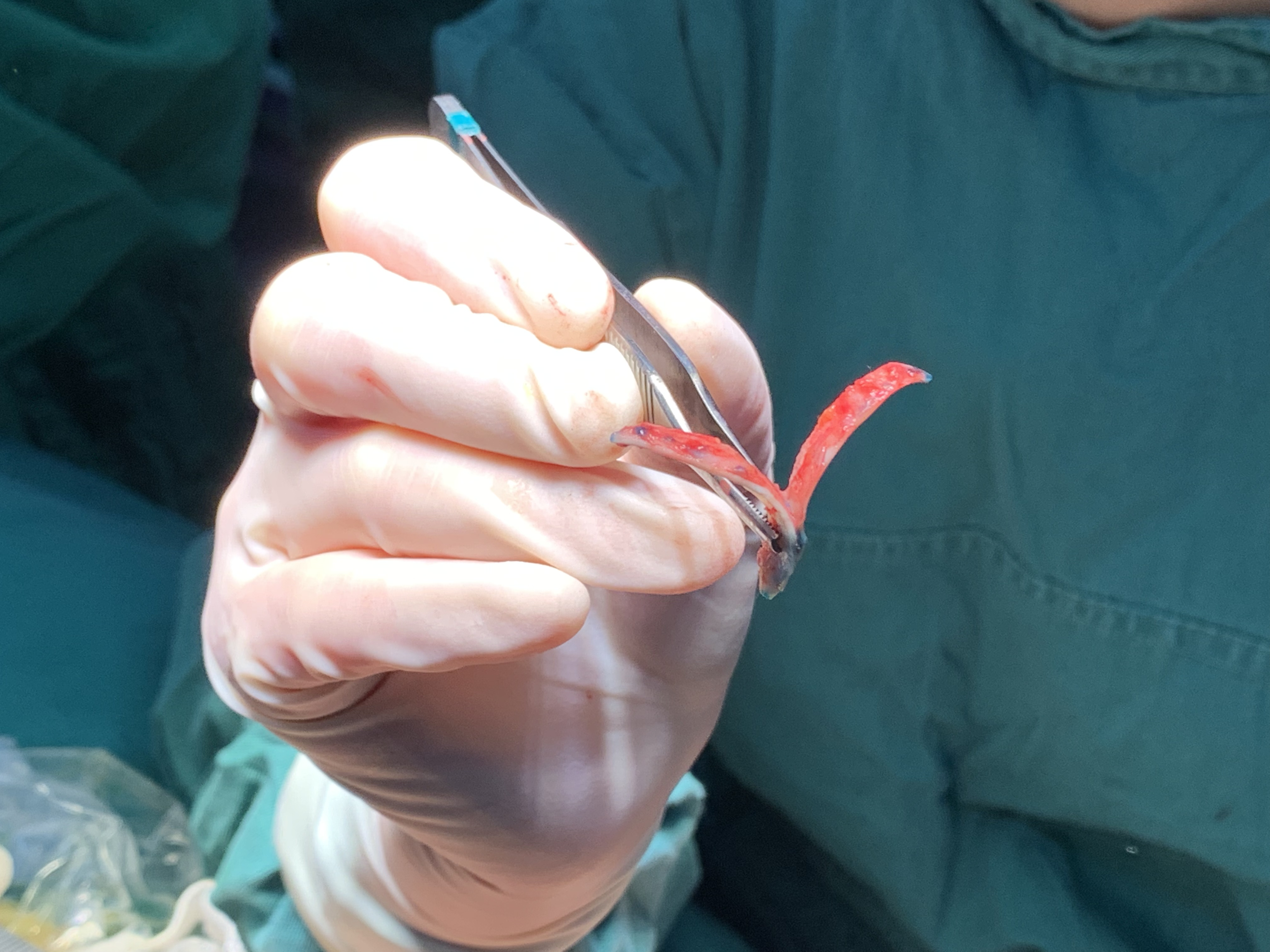 师:耳软骨切取的方法不一样,支架搭建的方法也不一样,当然效