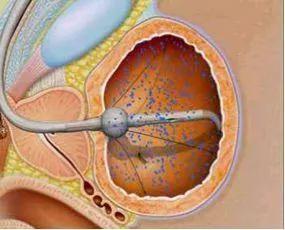 膀胱癌患者术后为什么要灌药,灌的都是哪些药?