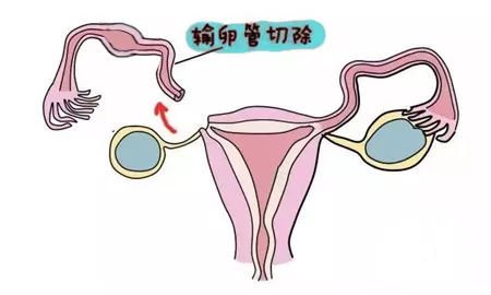 一,确定输卵管通畅情况