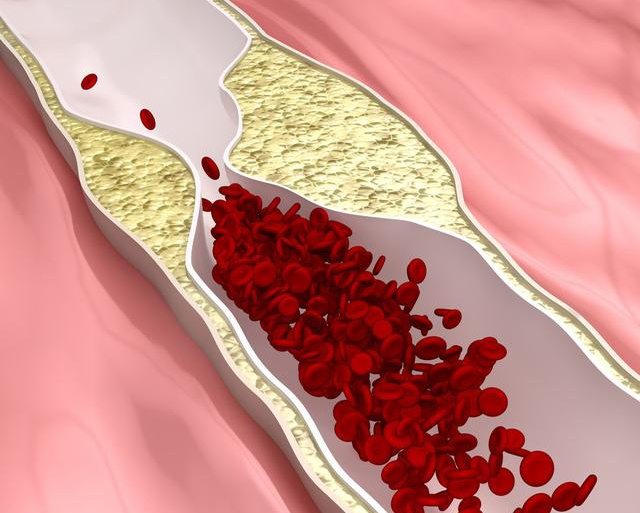 辟谣:医生看到心脏血管狭窄就放支架?医生:绝无此事!