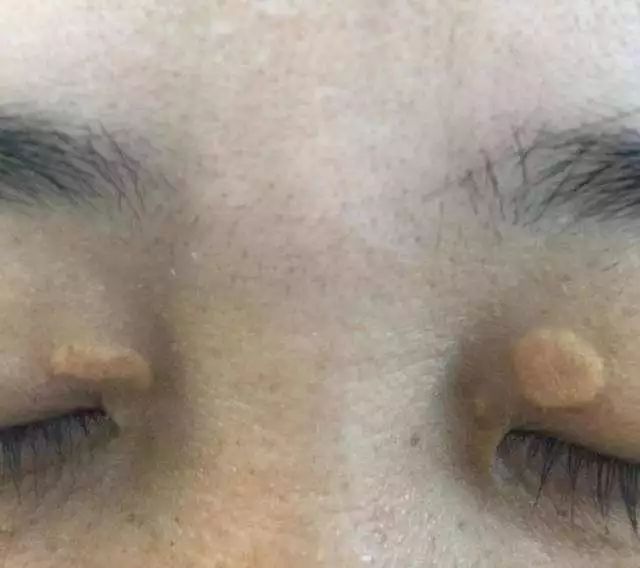 小心你眼周的睑黄瘤