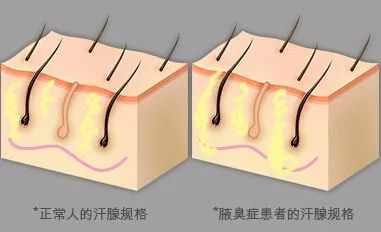 腋臭治療後的這一項併發症你能接受嗎