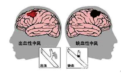 脑出血和脑梗塞的区别