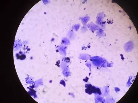 真菌感染,这里说的真菌主要就是马拉色菌脂溢性皮炎出现的原因:但它