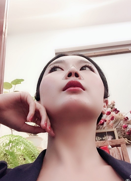 9496术后仰面969498通过肋软骨雕刻的鼻尖鼻头改善了鼻孔的