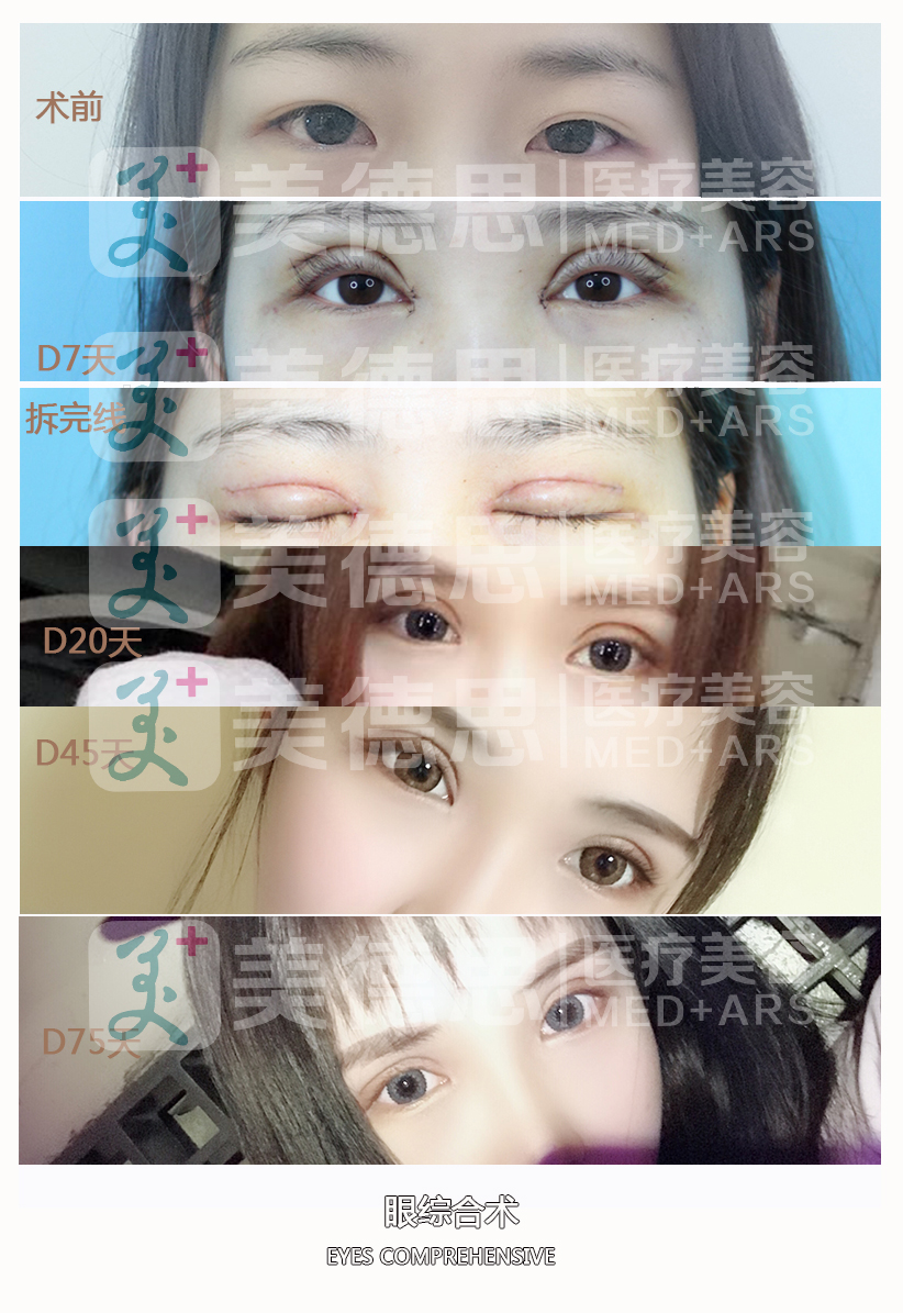 眼综合术后75天恢复对比照