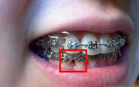 大部分人都觉得是牙套让自己牙龈萎