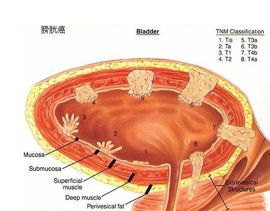 膀胱癌患者術後為什麼要灌藥,灌的都是哪些藥?