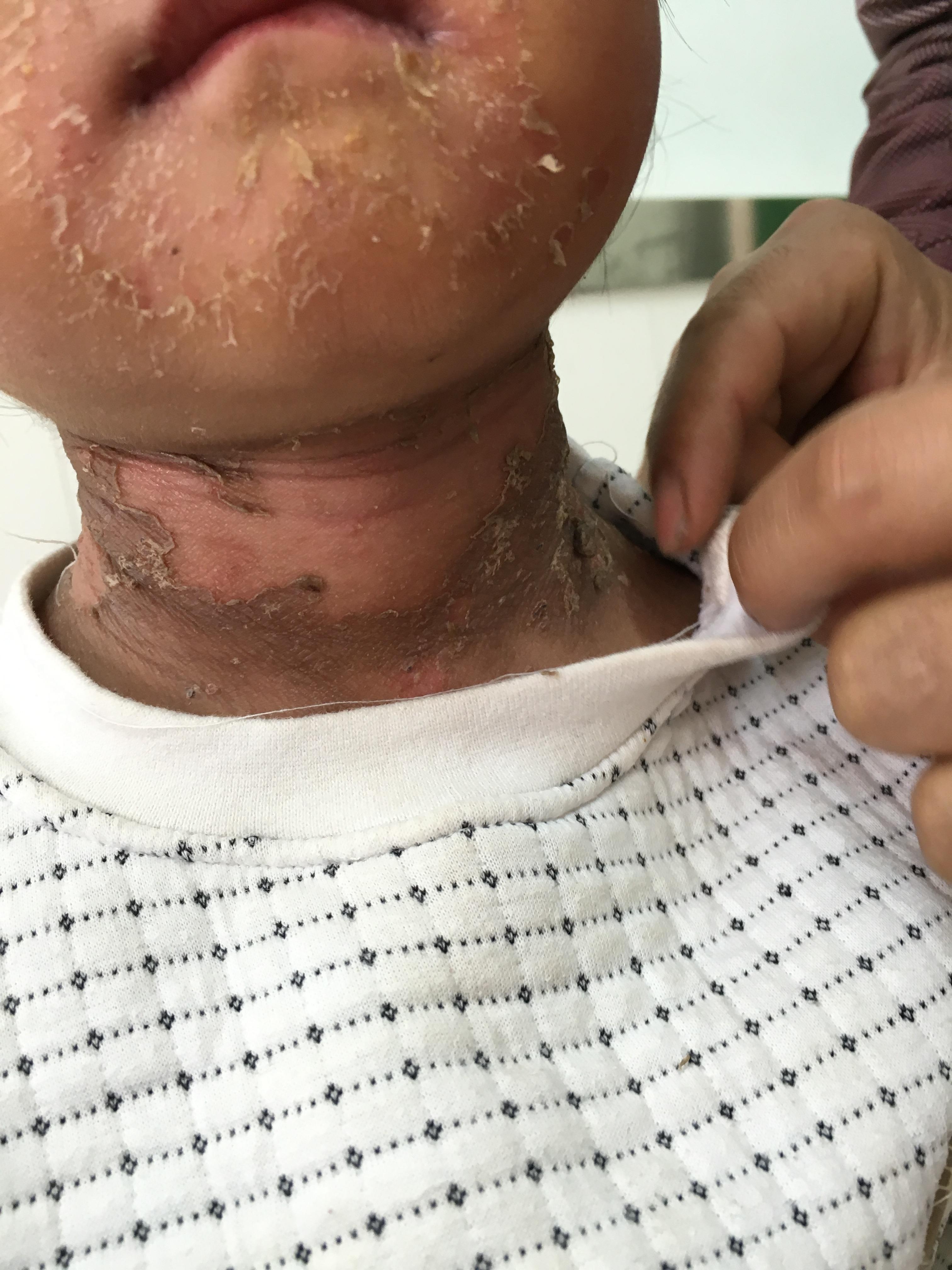 葡萄球菌烫伤样皮肤综合征(ssss)