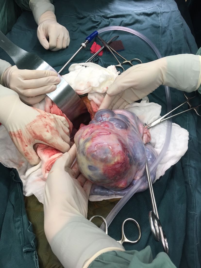 巨大盆腔包块—-卵巢癌