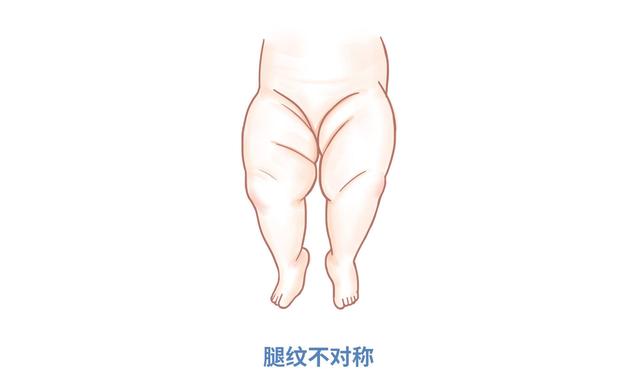 婴儿臀纹不对称的图片图片