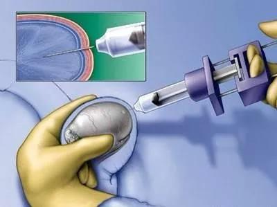 一文读懂克氏综合征