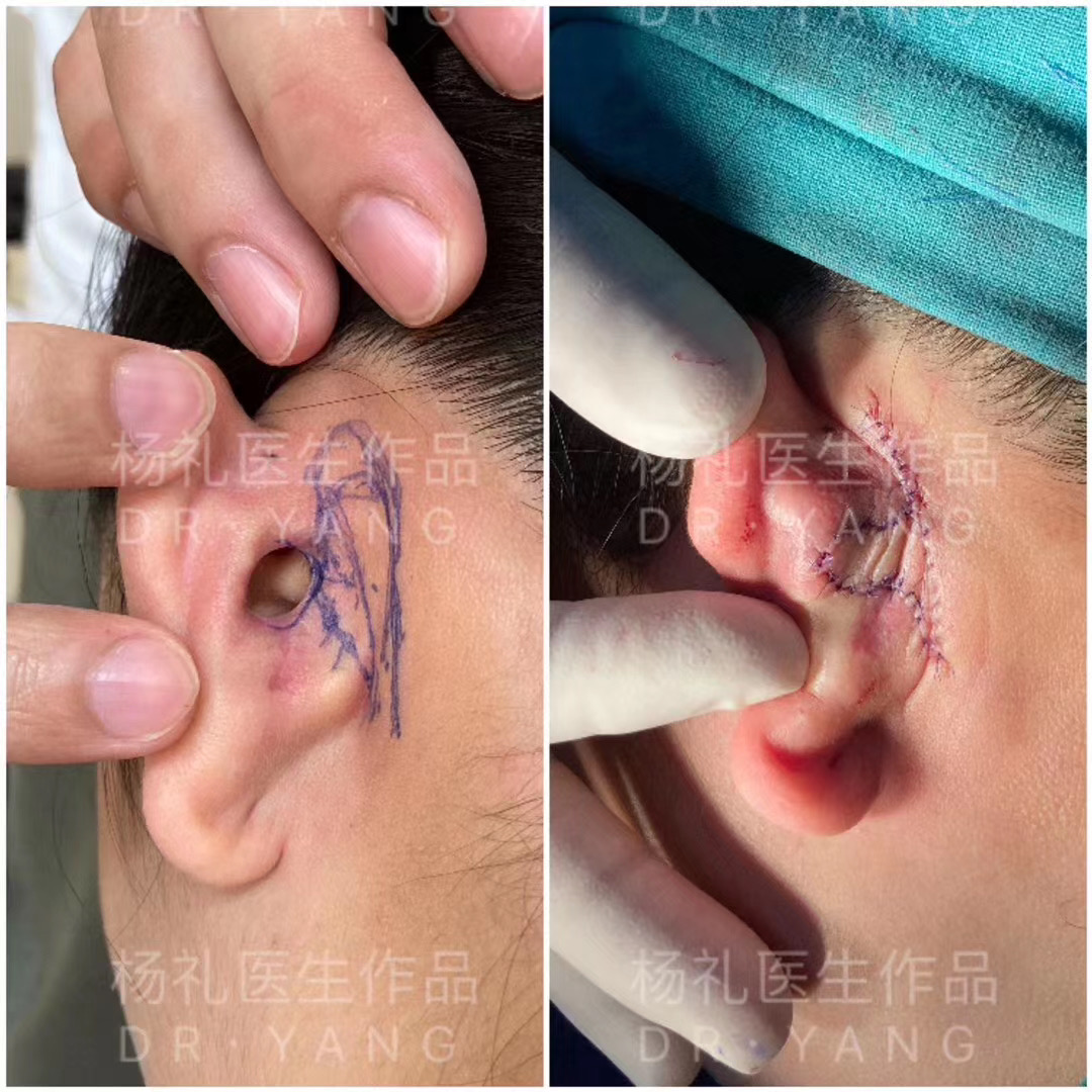 【修复方案】老杨采用了耳后旋转皮瓣的修复方法,将穿孔部位进行精细