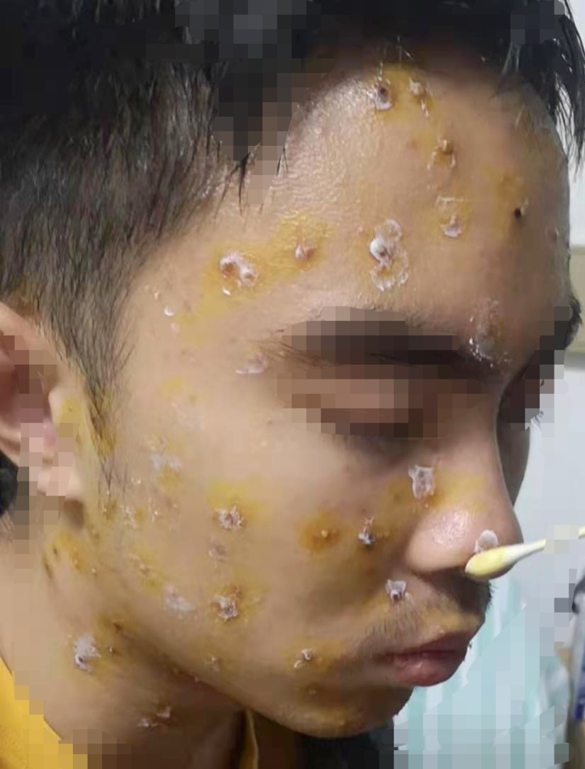 水痘带状疱疹病毒感染水痘水痘合并其他特指的并发症