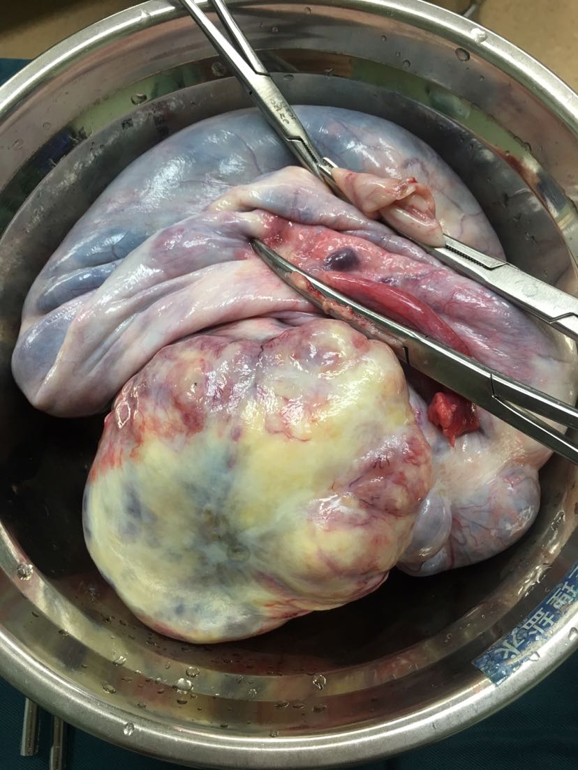 巨大盆腔包块—-卵巢癌