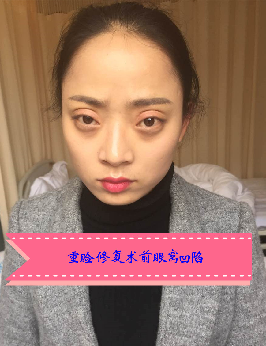 为什么切开双眼皮术后容易造成眼窝凹陷?