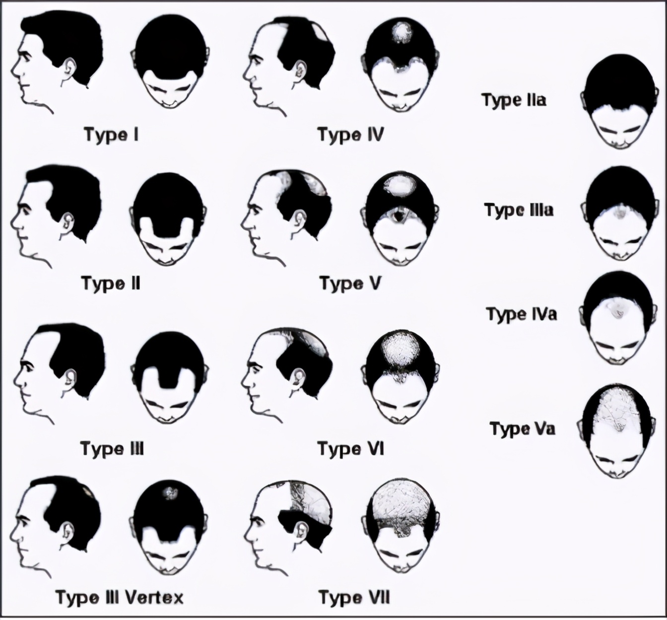 挺秃然的头秃青年们的福音请收下这份治脱发大全