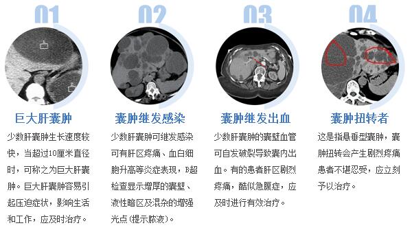 肝囊肿是怎么回事?