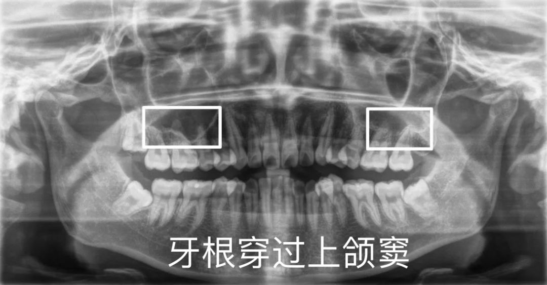 如果上颌牙的某些牙根进入了上颌窦内95那么这些牙齿在移动时受到的