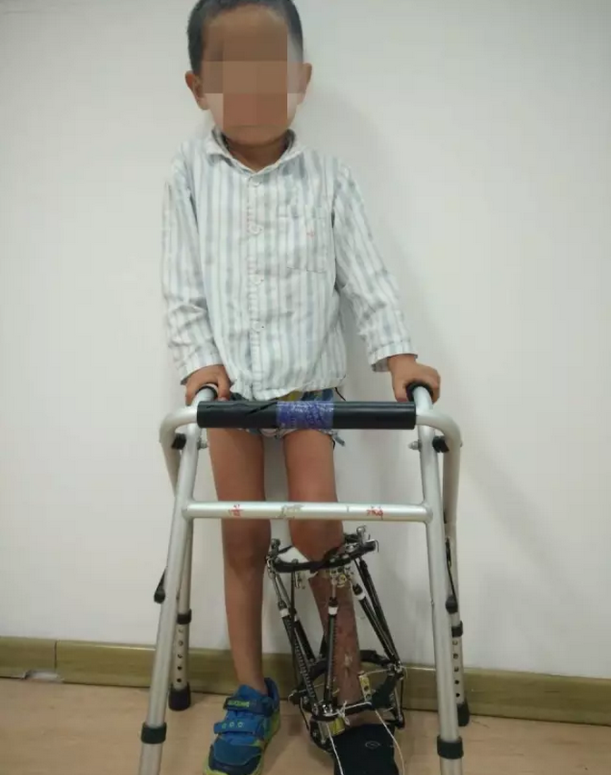 肢体延长矫形案例