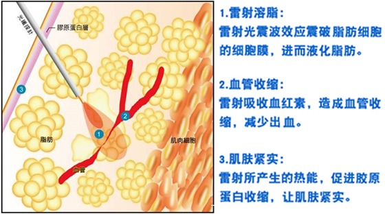雷射溶脂则是利用雷射波长将浅层脂肪溶解,再利用引流技术将脂肪取出