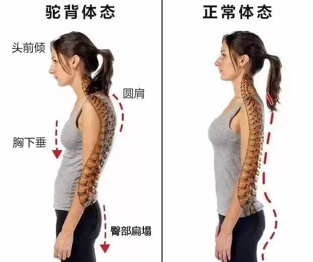 矫正体态神器背背佳是不是智商税