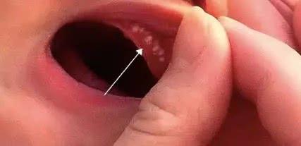 一般会在口腔牙龈边缘或上腭中线两旁出现单个或几个白色像米粒大小的