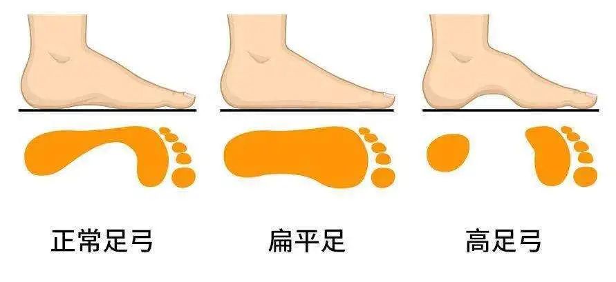 疑心自己扁平足?教你2秒辨认!